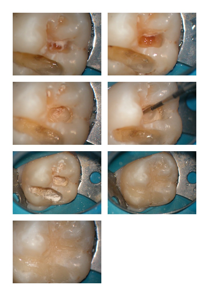 Failing FS in molar pg 2.jpg